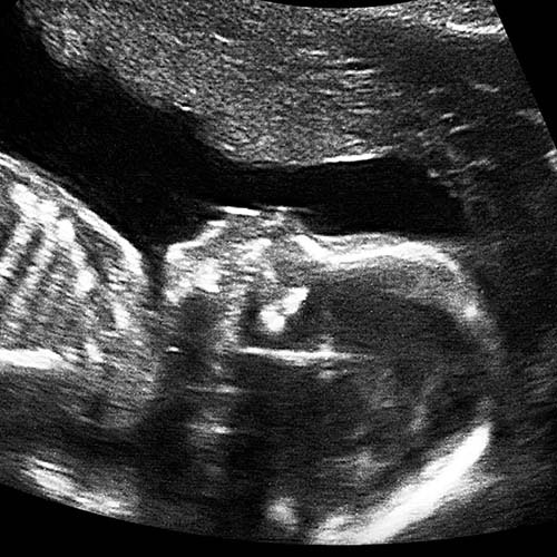 Ultrasound